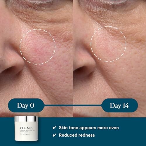 Before and after skincare comparison showing reduced redness and more even skin tone.